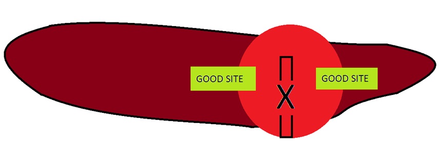 Splenic Nodules Image