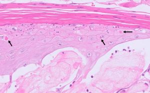 Eosinophilic intracytoplasmic inclusions