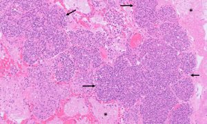Abundant degenerate neutrophils
