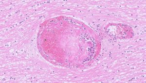 Vasculitis and thromboembolism