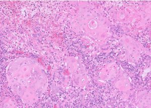 Clusters of neoplastic
