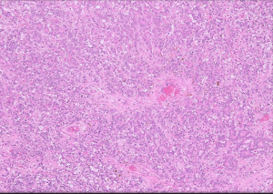 Higher power view of the neoplastic cells