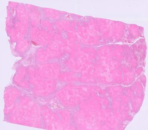 Lung tissue is near completely effaced