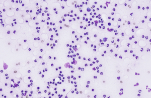 Figure 10 – Suppurative inflammation 