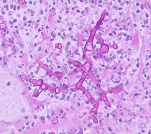 Fungal hyphae found in the wall of the abomasum