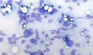 Figure 3. Excessive aspiration pressure causing widespread cell rupture (high grade lymphoma; Modified Wright’s, ×60).